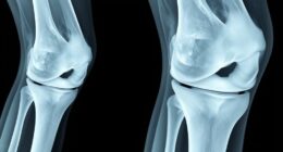 differenzieren Arthrose von Osteoarthritis