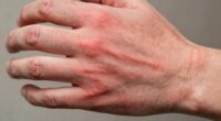 Chronische Entzündung schädigt die Gesundheit