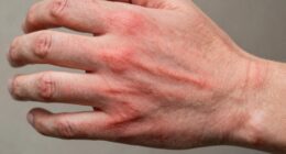 Chronische Entzündung schädigt die Gesundheit