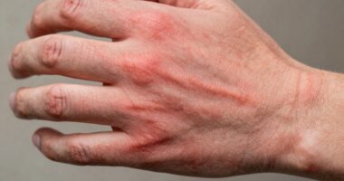 Chronische Entzündung schädigt die Gesundheit