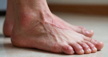 Fußpolyarthritis Schmerzen