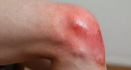 Gicht betrifft Kniegelenke