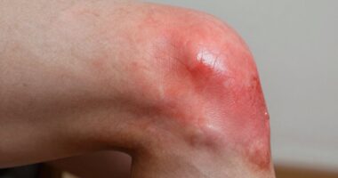 Gicht betrifft Kniegelenke