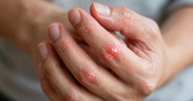 Handgelenkentzündung Behandlung