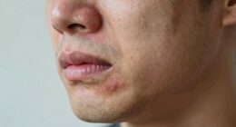 Kiefergelenk-Arthrose-Schmerzen