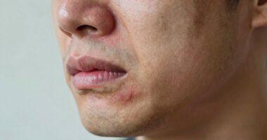 Kiefergelenk-Arthrose-Schmerzen