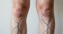 Bein Durchblutung Venen Schwere