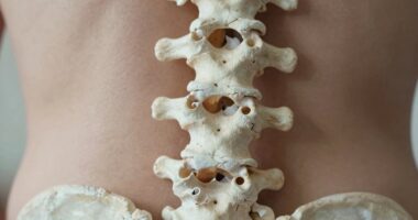 Osteoporose, die die Wirbel betrifft