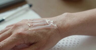 Osteoporose nach Frakturenmanagement