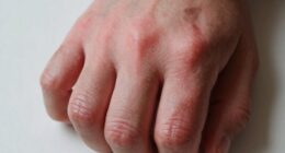 Geschwollene Finger zeigen Gelenkgesundheit