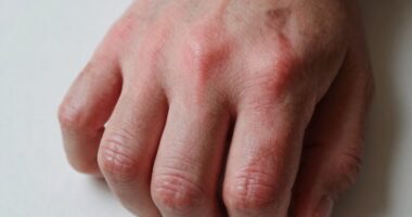 Geschwollene Finger zeigen Gelenkgesundheit