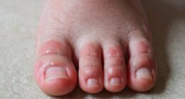 Schmerzen im Zehengelenk bei Arthritis