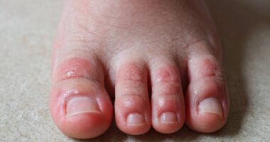 Schmerzen im Zehengelenk bei Arthritis