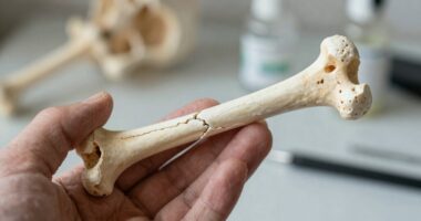 Verständnis von Osteoporose: langsame Knochenverluste