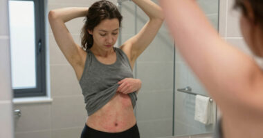 7 Places on the Body That Hidradenitis Suppurativa Can Appear