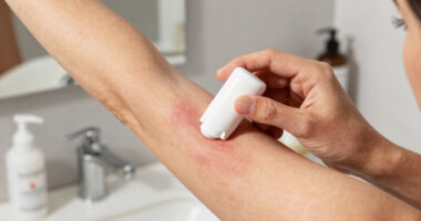 Deodorant Armpit Rash: Causes, Prevention, and Treatment